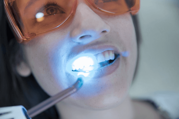 Foto-Clareamento-dental-1