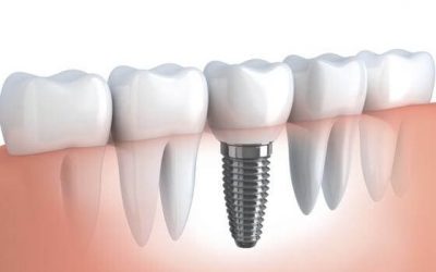 Implante Dentário |Mitos e Verdades que Precisa Saber
