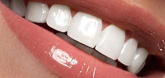 Lente de contato dental | Quais casos são indicados