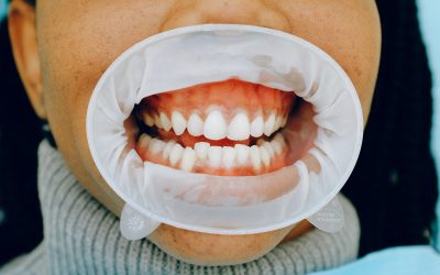 Lente de contato dental l O que devo saber antes de usar