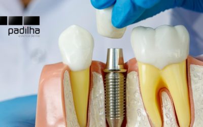 Implantes Dentários | Respondemos as 5 principais dúvidas