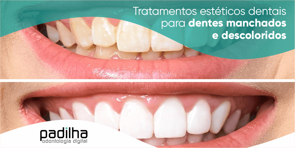 Tratamentos Estéticos Dentais Para Dentes Manchados e Descoloridos