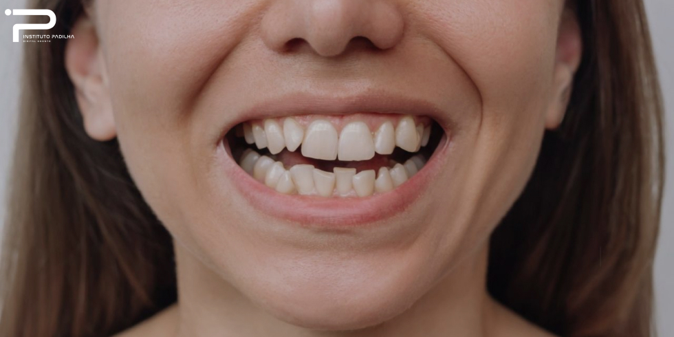 Dente Encavalado: Quais os Tratamentos Indicados?
